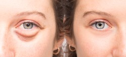 Female face before and after blepharoplsty with and without eye bag