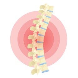 Spine deformation flat vector color isolated illustration. Kyphosis, back pain cartoon design element on white. Postural syndrome concept clipart. Spinal disease, disorder, posture problem