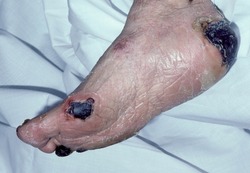 Gangrenous wounds of the foot
