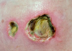 Infected pressure sores in a nursing home