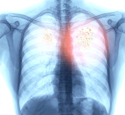 Lung Cancer,Pneumonia or emphysema . X-ray image of patient chest for check up lung disease.