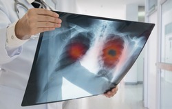 Lung Cancer or Pneumonia. Doctor check up x-ray image have problem lung tumor of patient.
