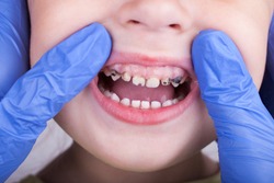 Dental medicine and healthcare - dentist examining little child girl patient open mouth showing caries teeth decay