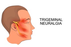 illustration of a male head. trigeminal neuralgia. neuroscience