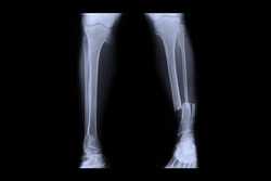 closed fracture left leg , ( Xray both leg ) 
