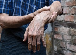 Radial nerve injury or wrist drop of Asian elder man.