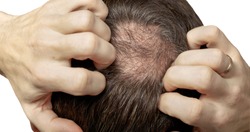 Man with hair loss problems closeup, isolated. Alopecia balding hairs on man scalp. Human alopecia or hair loss - person hand pointing his bald head. Scratching his head. Baldness. Depression, stress
