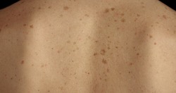 Close-up of large rashes or smallpox on the skin of an adult male. Pigmented spots on the back of a man. Skin of a man with moles. Acne.