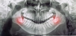 different types of wisdom teeth problems concept, problem teeth X-ray image scanned, panoramic image
