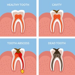 Stages of tooth decay. Dental anatomy concept. Vector illustration.