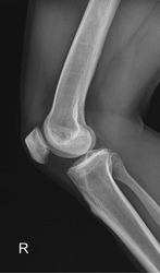 X-ray of the human knee joint, offering a detailed look at the patella, femur, tibia, and fibula.