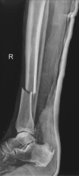 Detailed X-ray image showcasing a tibia fracture, with clear fracture lines.
