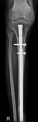 Close-up X-ray of a tibia fracture after successful intramedullary nail fixation.