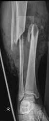 x-ray image of a broken tibia and fibula 
