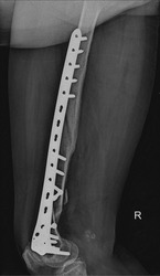 Detailed X-ray image revealing a fractured femur, highlighting the extent of the orthopedic injury and potential surgical considerations.