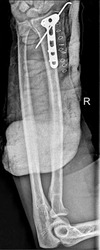 Orthopedic X-ray images providing a clear view of a tibia fracture fixation using an intramedullary nail.