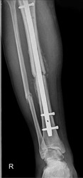 X-ray image showing a tibia and fibula fracture with the tibia fixed using an intramedullary (IM) nail