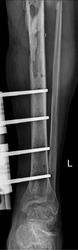 X-ray image showing external fixation of the lower limb, specifically the tibia.