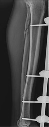 Radiographic view capturing the successful fixation of a tibia-fibula fracture. The image displays the precise alignment of the fractured tibia and fibula, stabilized with orthopedic hardware.