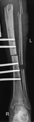 X-ray image showing the anterior-posterior (AP) view of tibia and fibula fracture fixation.