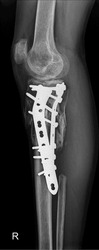 Lateral radiograph illustrating effective fixation of a proximal tibia and fibula fracture. The image reveals the precise alignment of the fractured bones, secured with orthopedic plate.