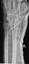 X-ray providing a detailed view of the distal tibia, fibula, and ankle joint, crucial for assessing trauma-related injuries. This radiograph highlights fractures, joint alignment.