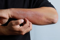 Close up dermatitis on man hand, allergic rash dermatitis eczema skin of a patient. Atopic dermatitis symptom skin detail texture, Fungus of skin. The concept of dermatology.