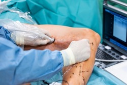 Varicose veins surgery act, superficial veins problems, swollen skin