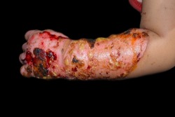 Burn wound surrounded by scabs and exsudates in hand and forearm of Southeast Asian child. Closeup view.