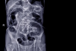 X-ray of the patient's stomach showing gas in the intestines. and bowel obstruction