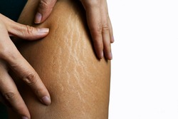 Close up female legs with stretch marks
