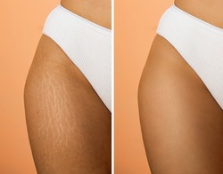 Image compare before and after Woman legs with stretch marks removal treatment, real people. Skin care concept.
