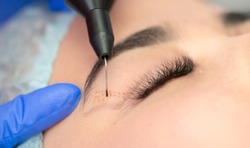 Cosmetic procedure to strengthen the skin of the eyelids. Non-surgical blepharoplasty on plasma IQ apparatus. Cosmetology for facial rejuvenation.