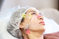 Thread lifting is a cosmetological procedure for face rejuvenation. The beautician implants cosmetic threads under the skin to relieve facial ptosis.