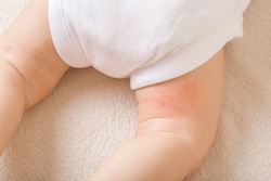 Infant bare leg with red rash on skin. Suffering from allergy of milk formula, mother milk or other food. Care about baby body. Closeup. Top down view.