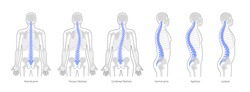 Spinal deformity flat vector illustration. Kyphosis, lordosis and scoliosis of spine infographics.. Body posture defect. Medical, educational and science banner
