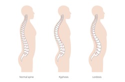 Spinal deformity flat vector illustration. Kyphosis, lordosis of spine infographics. Diagram with spine curvatures and healthy backbone. Body posture defect. Medical, educational and science banner.