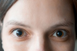 Close-up of a woman's brown eyes with dilated big pupils. Eye drops after a visit to an ophthalmologist. Concept of healthy vision. Ophthalmological examination and treatment.
