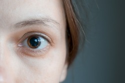 Close-up of a woman's brown eye with dilated big pupil. Eye drops after a visit to an ophthalmologist. Concept of healthy vision. Ophthalmological examination and treatment.