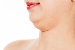 A woman has a lot of fat on her chin.