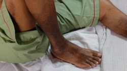 Blackish discoloration of bilateral lower limb or hyperpigmentation due to Chronic Venous Insufficiency and DVT.