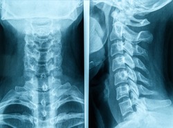 Photo of human neck X-ray image