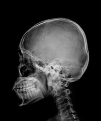head skull x-ray side view 