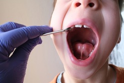 dentist, doctor examines oral cavity of small patient, length of frenum, boy, kid performs articulation exercises for mouth, concept of speech disorders, correction, selective focus on bridle of tongu