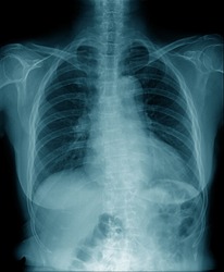 chest x-ray , hight quality chest x-ray image in blue tone 