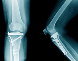 x-ray image of knee, tibia fracture with post operation internal fixation 
