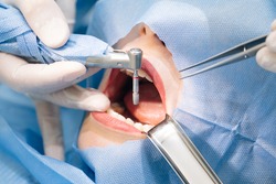 Close-up shot of attentive doctors performing surgical operation installing dental implants into patient's mouth in modern dental clinic. Dental instruments. Stomatology clinic. Dental surgery.