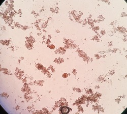 Ascaris lumbricoides fertilized egg (roundworm) in stool, analyze by undermicroscope.