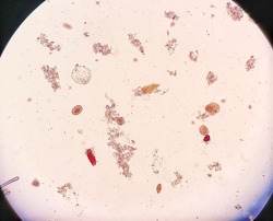  Ascaris lumbricoides fertilized egg (roundworm) and Trichuris trichiura egg in stool, analyze by undermicroscope.