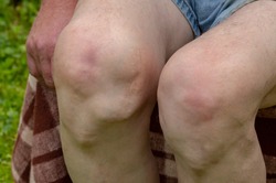 Sick legs of an old man with severely deformed knees affected by arthritis. Joint and bone problems. Arthrosis. Autoimmune diseases.  Health and diseases.Focus on the knees.